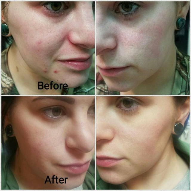 Dermaplaning - Full Facial w/ Eva - Image 2